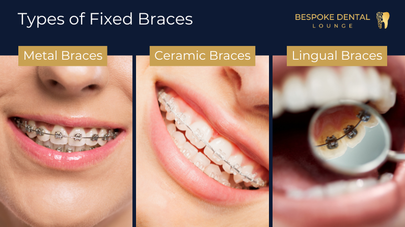 types-of-fixed-braces